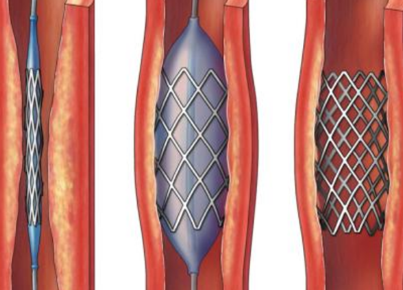 好消息！700元冠脈支架來(lái)了帶量采購(gòu)結(jié)果在甘肅省正式落地執(zhí)行